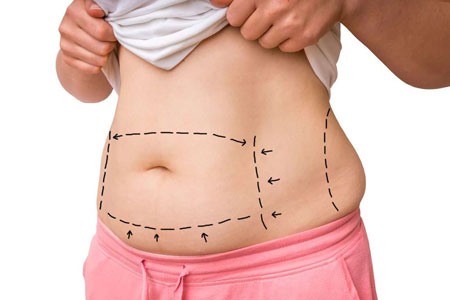 AESTHETICS AFTER BARIATRIC SURGERY