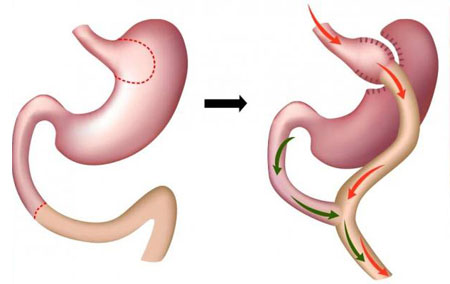 mide bypass gastrik