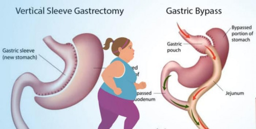Comparison of Sleeve Gastrectomy and Gastric Bypass